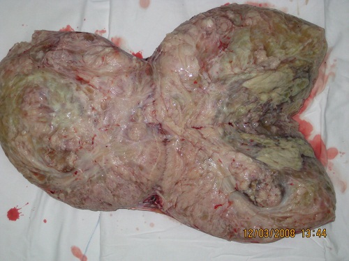 Phẫu thuật khối u khổng lồ nặng 27kg