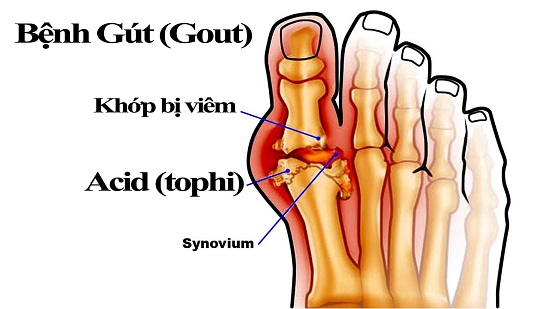 Top 10 nguyên nhân gây bệnh Gout