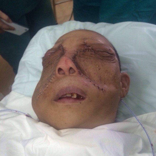 Phẫu thuật thành công cho bệnh nhân có khối u khổng lồ trên mặt