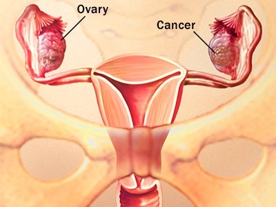 Tiến trình ung thư buồng trứng hoạt động